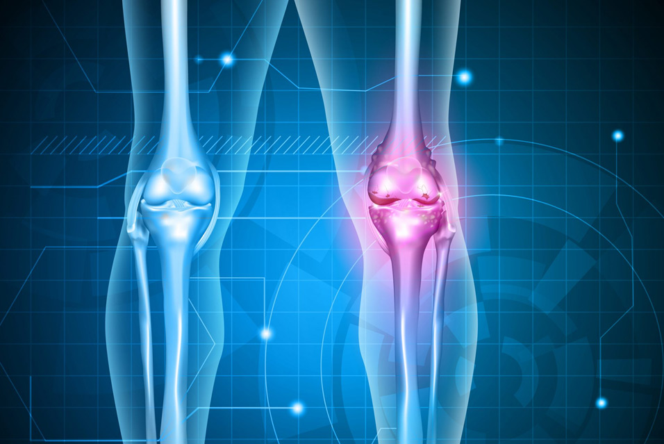 Хондросаркома