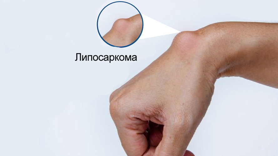 Лечение липосаркомы в Израиле