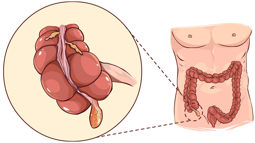 Лечение рака слепой кишки