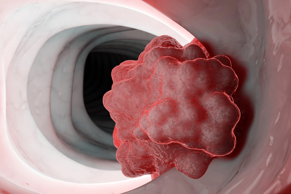 Рак двенадцатиперстной кишки