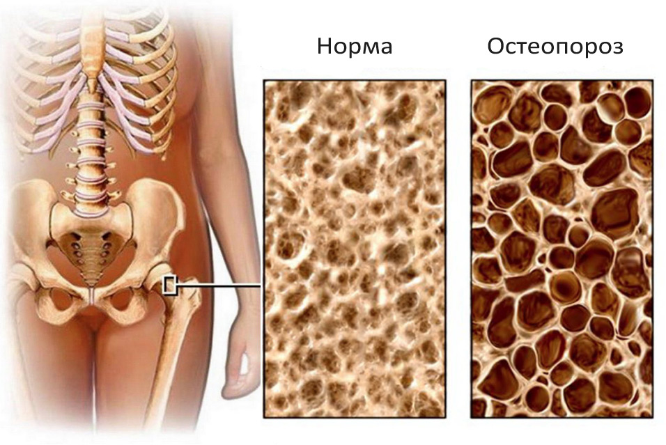 Лечение остеопороза в Израиле