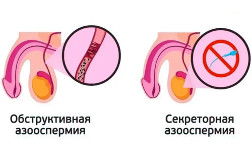 азооспермия