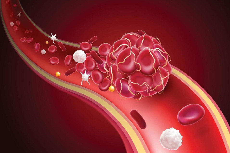 Лечение гемофилии в Израиле