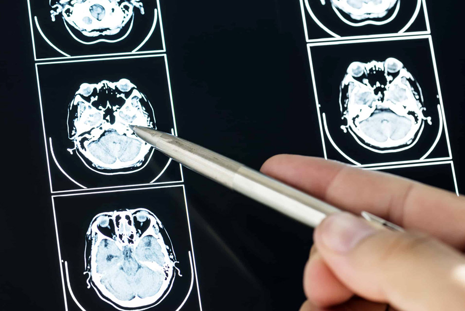 Глиома хиазмы