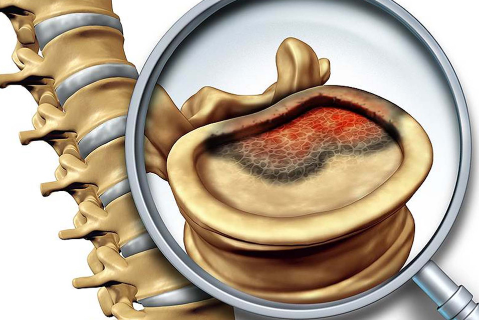 Лечение остеобластомы позвоночника в Израиле