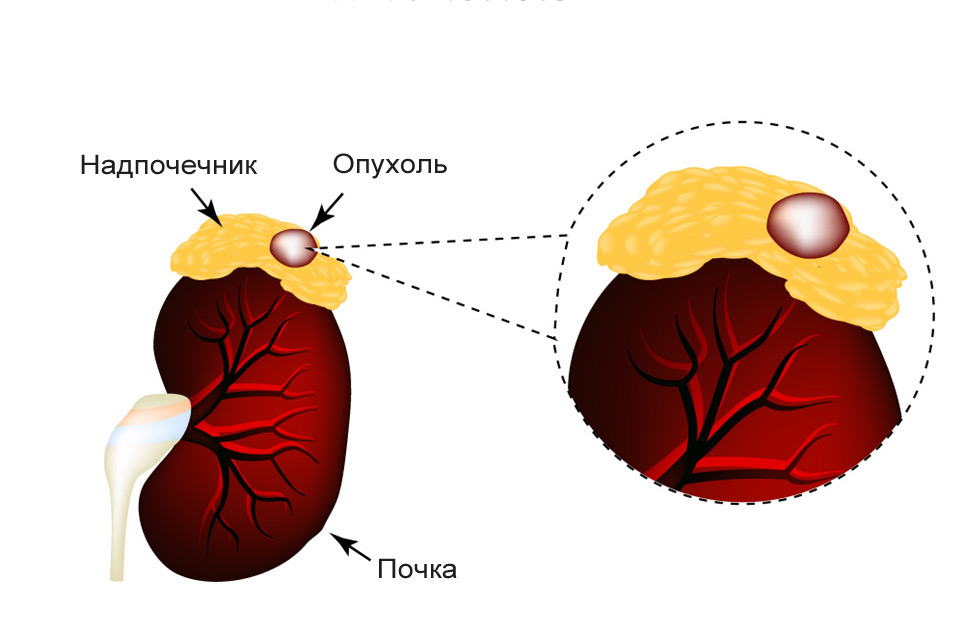 Лечение рака коры надпочечников в Израиле
