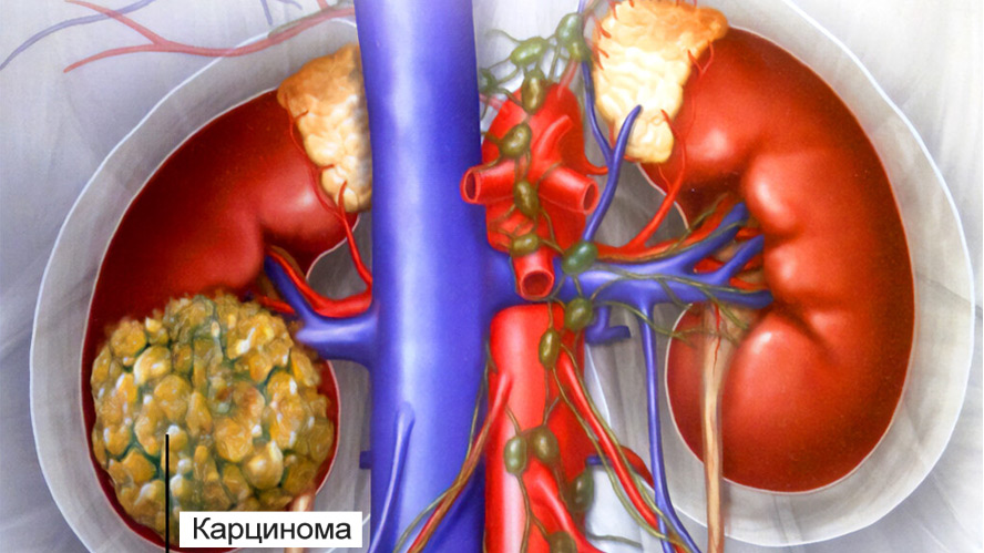Лечение карциномы почек в Израиле