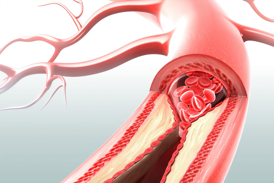 Лечение мезентериальной ишемии в Израиле