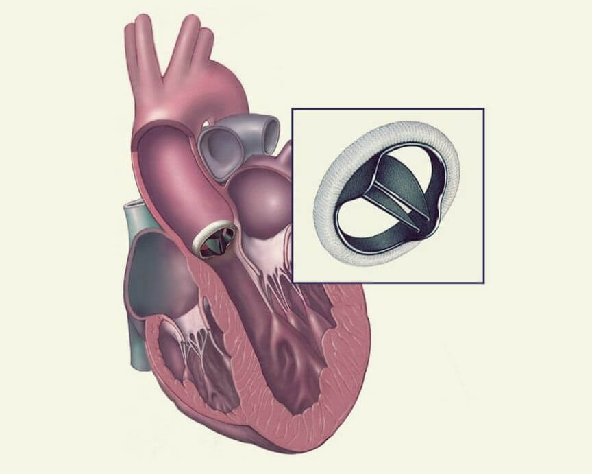 Замена сердечных клапанов