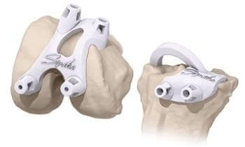 3D моделирование протезов суставов Signature Knee