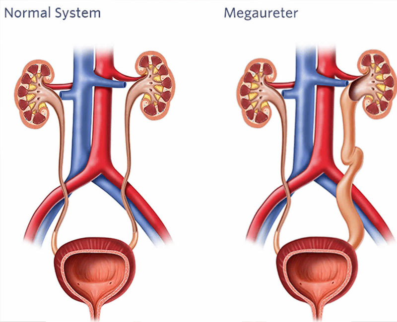 Мегауретер (гидроуретеронефроз)