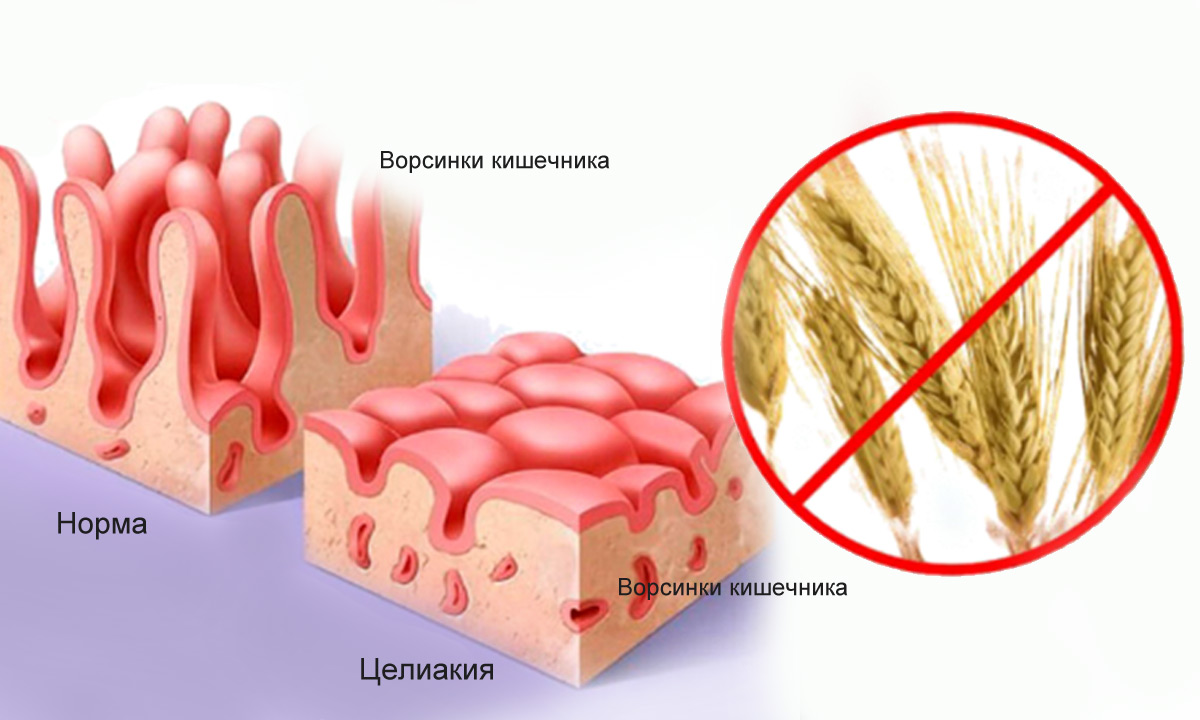 Лечение целиакии в Израиле