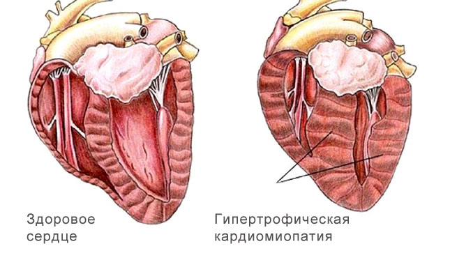 гипертрофическая кардиомиопатия