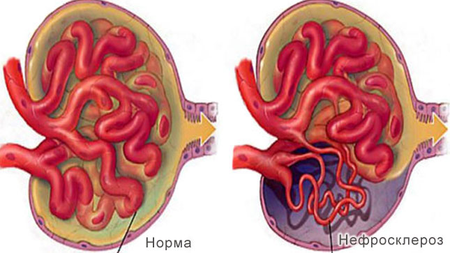 нефросклероз