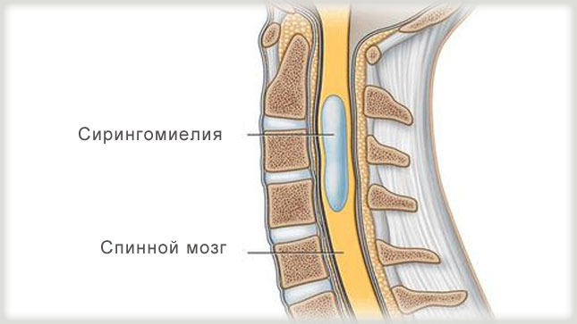 сирингомиелия