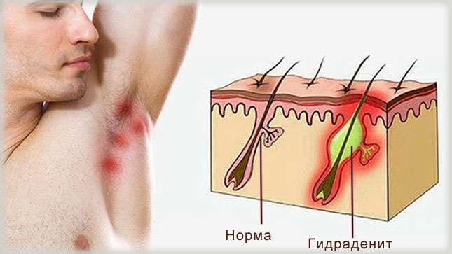 гидраденит