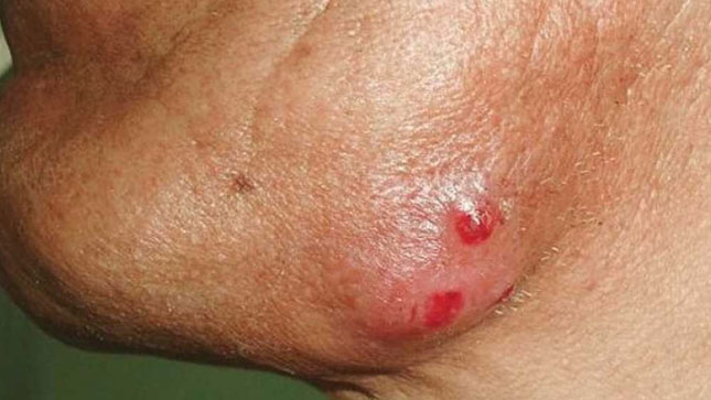 актиномикоз