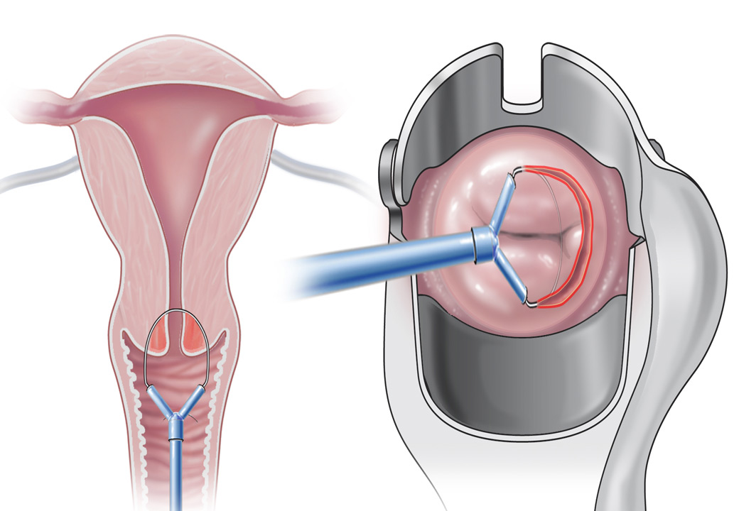 Конизация шейки матки